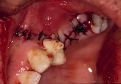 Sutures vzgxss - Eugenol