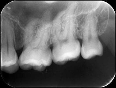 Transplantation de dds 28 w8tbre - Eugenol