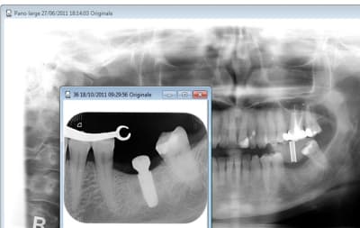 Tube hmlocd - Eugenol