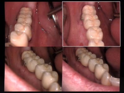 Un cas difficile bridge scellé sur piliers vissés sur implants 47 et 46 et 45 et 44   2 gg16e6 - Eugenol