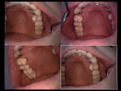 Un cas difficile implants une vue presque finale 3 yiml8e - Eugenol