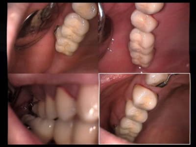 Un cas difficile implants une vue presque finale tsw4x6 - Eugenol