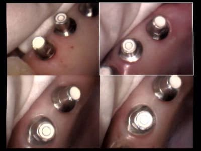 Un cas difficile piliers sur implants 25 et 26 et 27 avant scellement 1 ckusfv - Eugenol