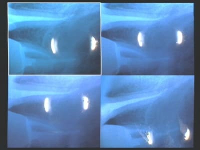 Une endo laser v0byey - Eugenol