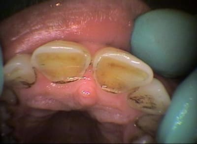 Usure palatine uwtmkr - Eugenol