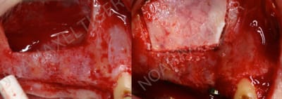 Volet sinus repositionn  h0pner - Eugenol