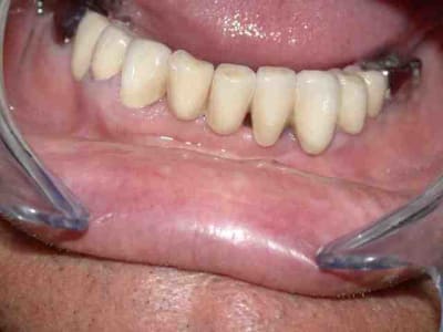 Vue vestibulaire ggzvym - Eugenol