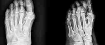 X-ray images of human feet. The left image shows a top view of a foot with visible bones, while the right image displays a side view. Both images highlight the skeletal structure on a black background.