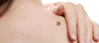 Close-up image of a person’s back showing a raised, round mole with a slightly uneven surface. The person is touching their upper back with their right hand, and the background is white.