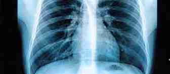 An X-ray image of a human chest showing the ribcage, spine, and surrounding tissues. The lungs are visible with the heart positioned slightly to the left side of the image. The ribcage's curvature and the overall structure of the thoracic cavity are clearly outlined.
