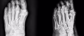 X-ray images of human feet. The left image shows a top view of a foot with visible bones, while the right image displays a side view. Both images highlight the skeletal structure on a black background.