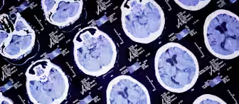 A medical scan display showing multiple brain CT images. The images exhibit various cross-sectional views of a brain with different levels of detail and shading, depicting potential abnormalities or normal structures. Accompanying data and measurements are present around the images.