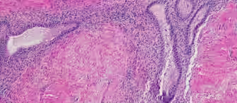 Histopathology image showing tissue stained with hematoxylin and eosin (H&E). The pink areas represent the extracellular matrix and cytoplasm, while the purple areas indicate nuclei and cellular components. The image shows an intricate arrangement of cells.