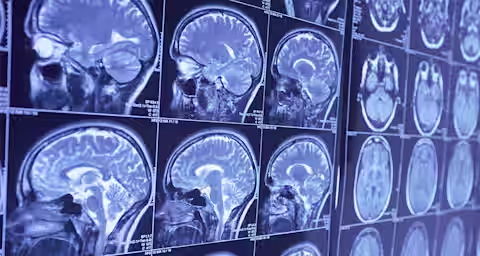 Multiple MRI scans of a human brain displayed on a screen. The images show various cross-sectional views, including sagittal and axial slices, revealing intricate details of the brain's structure. The scans are in shades of blue and gray.