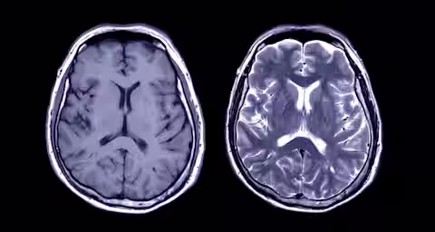 Two MRI brain scans are displayed side by side against a black background. The scan on the left shows a clear, detailed cross-section of the brain's structure in a darker contrast, while the scan on the right highlights the brain with more intense white and gray areas.