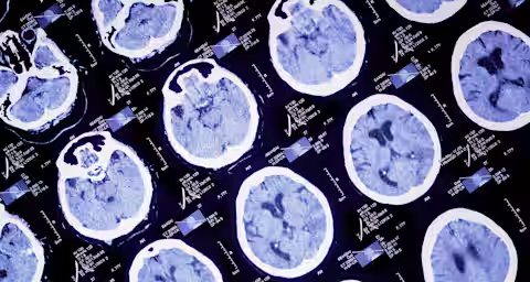 A medical scan display showing multiple brain CT images. The images exhibit various cross-sectional views of a brain with different levels of detail and shading, depicting potential abnormalities or normal structures. Accompanying data and measurements are present around the images.
