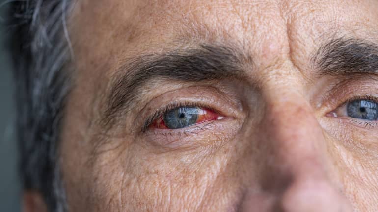Eye inflammations