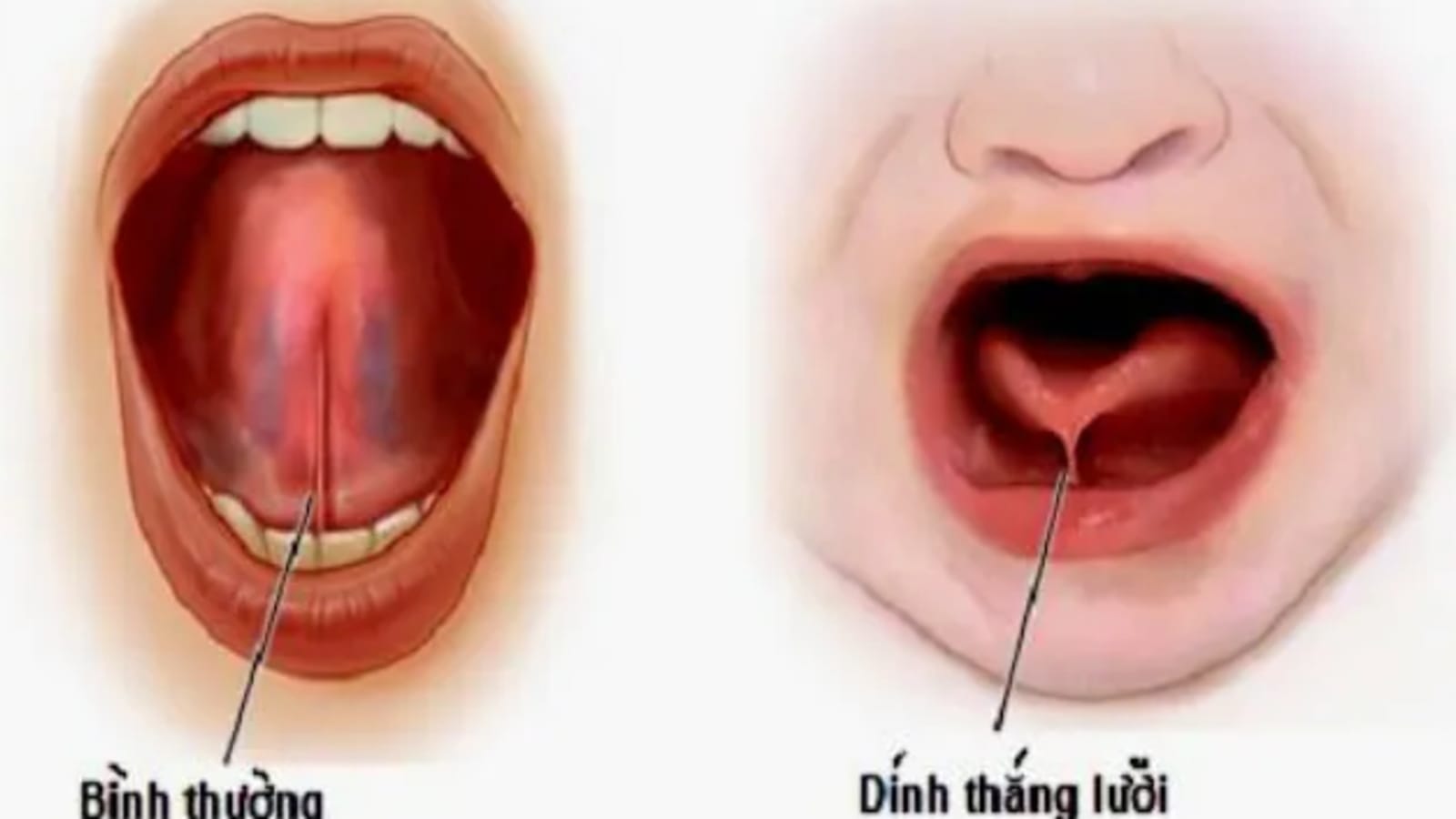 cắt phanh lưỡi