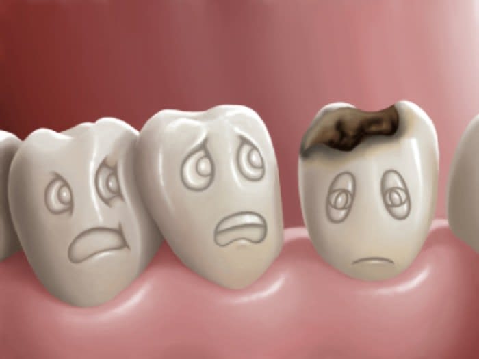 Nguyên nhân dẫn đến tình trạng sún răng ở trẻ