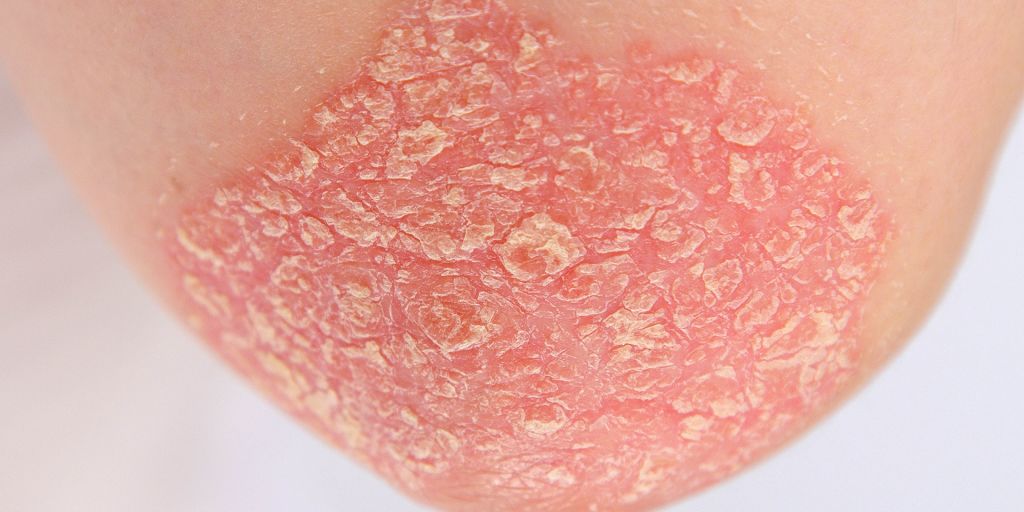 How to recognize different types of psoriasis sharecare