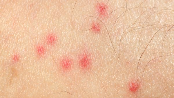 Identifying Insect Bites: Pictures Of 11 Common Bug Bites