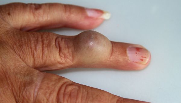 Large, rounded epidermal cyst on the left ring finger of a person with dark skin