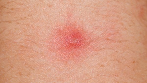 Inflamed circular bump or blemish on a person with light skin