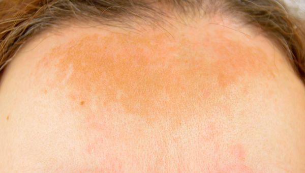 melasma, sun damage, skincare, sunburn