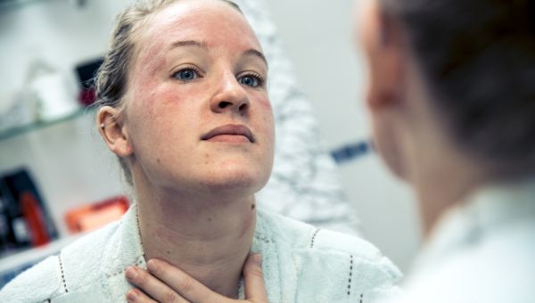 7 Answers About Angioedema Skin Disorders Sharecare