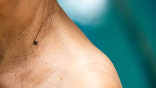 Surprising Spots to Check for Skin Cancer | Skin Cancers ...