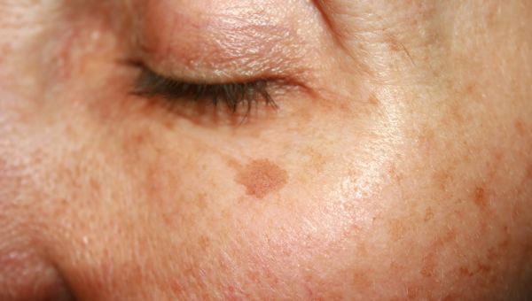 What Does Skin Cancer Really Look Like? | Skin Cancers ...