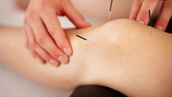 acupuncture treatment on a woman's knee