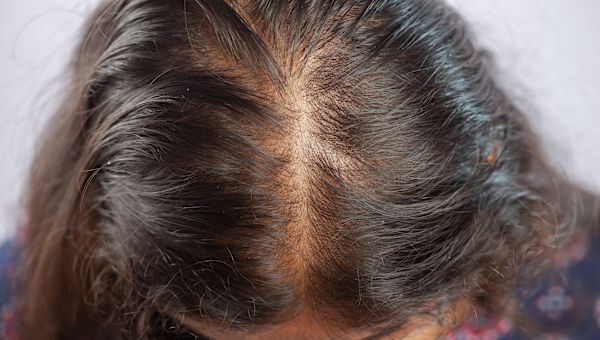 woman with androgenetic alopecia