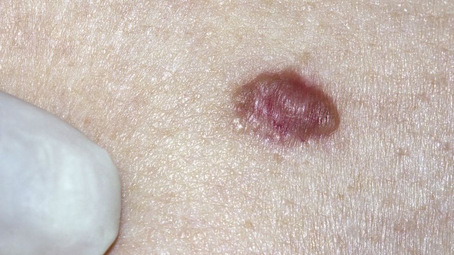 basal cell carcinoma