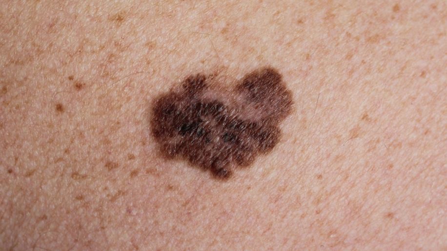 closeup of melanoma