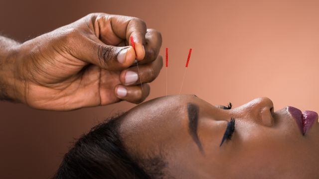 close up of woman's face receiving acupuncture