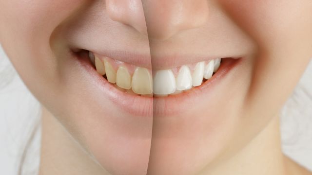 Before and after pic of OTC teeth whitening. There are many teeth-whitening options, including store-bought and in-office.