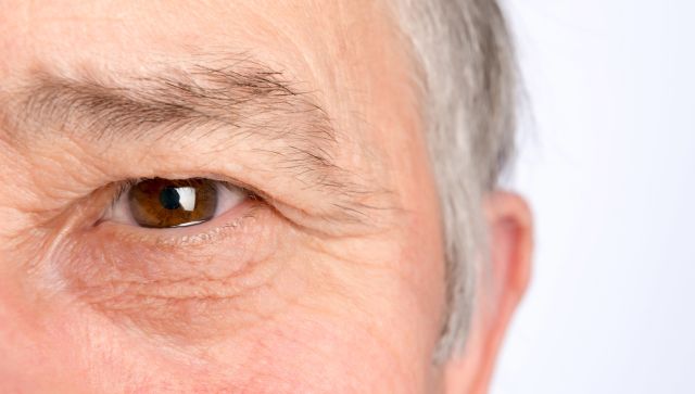 A man has aging eyelids, drooping with age. He wants to know how to fix droopy eyelids that are causing vision problems.