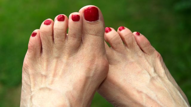 bunion
