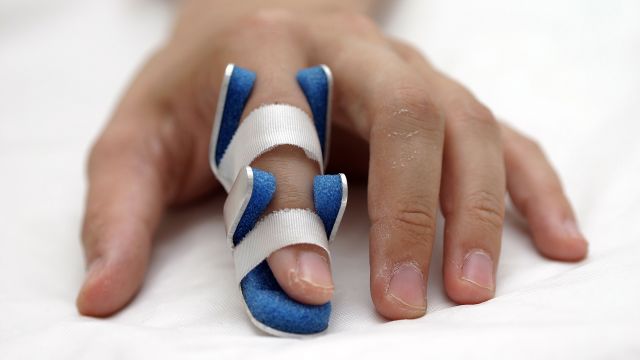 A badly sprained finger in a splint. Injury is one possible trigger for psoriatic arthritis.