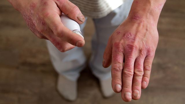 A man with psoriasis on his hands. The location and affect on quality of life are important criteria in categorizing psoriasis severity.