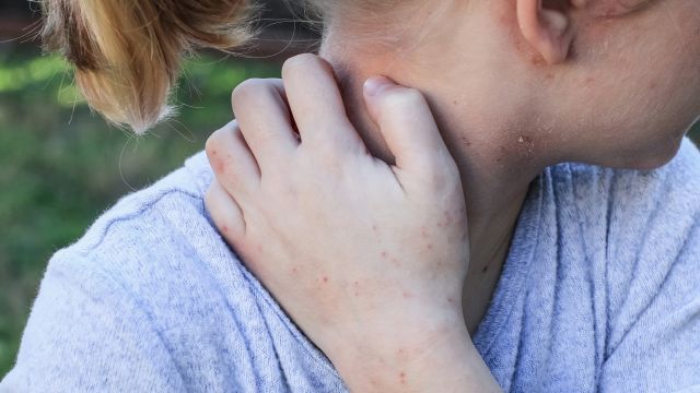 A young psoriasis patient scratches her neck.