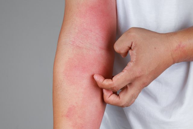 Itching is considered the defining symptom of atopic dermatitis, and atopic dermatitis is sometimes referred to as “the itch that rashes.”
