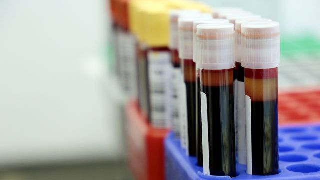 Blood vials in a medical laboratory waiting to be tested for anemia.