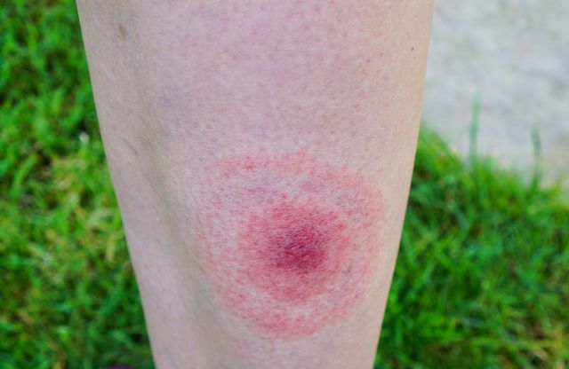 a close-up image of a Lyme disease bull's-eye rash, also called erythema migrans, on a person's lower leg
