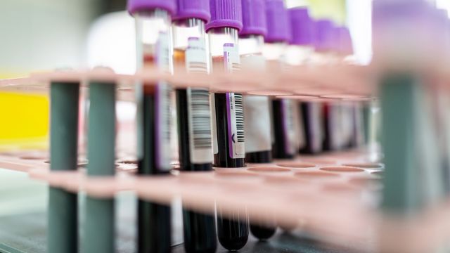 A tray of blood samples in a medical laboratory. Blood testing can be an important part of diagnosing and monitoring for lymphomas and leukemias.