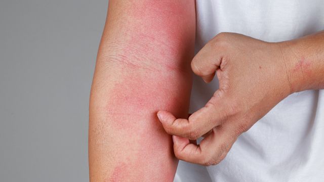 Itching is considered the defining symptom of atopic dermatitis, and atopic dermatitis is sometimes referred to as “the itch that rashes.”
