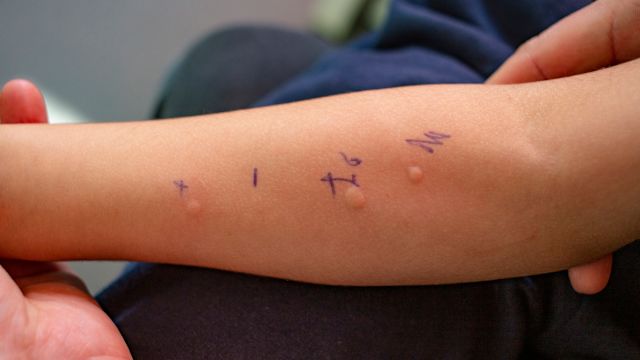 A child has a skin reaction to an allergen during a skin prick test. The skin prick test is one diagnostic test healthcare providers may use to diagnose food allergies.